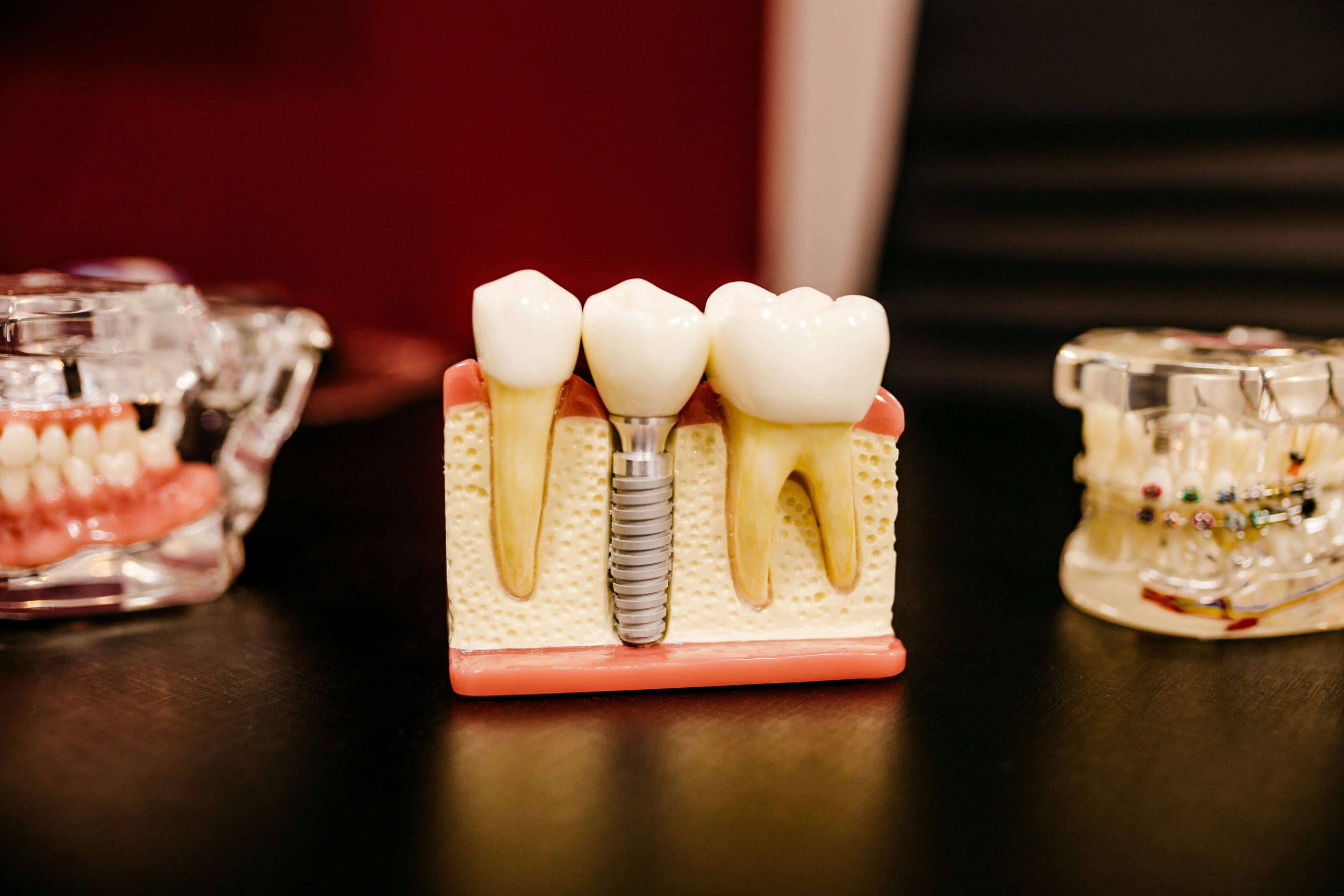 Implante Dentário