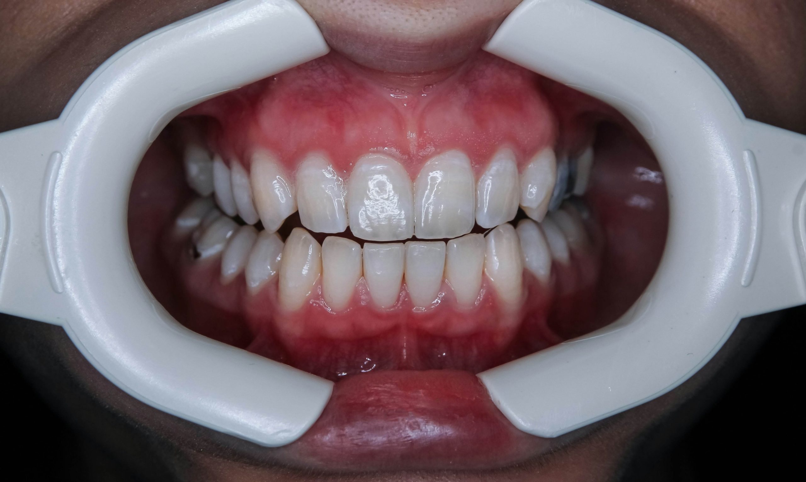 Clareamento Dental: Como Funciona e Quando é Indicado
