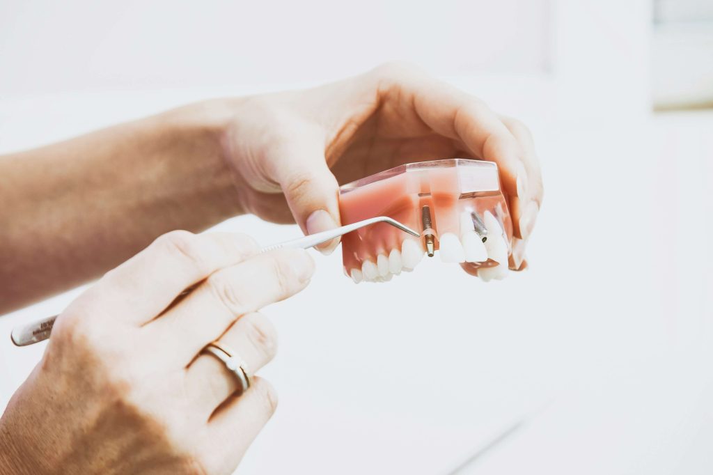 Implantes Dentários: Recupere Seu Sorriso com Segurança