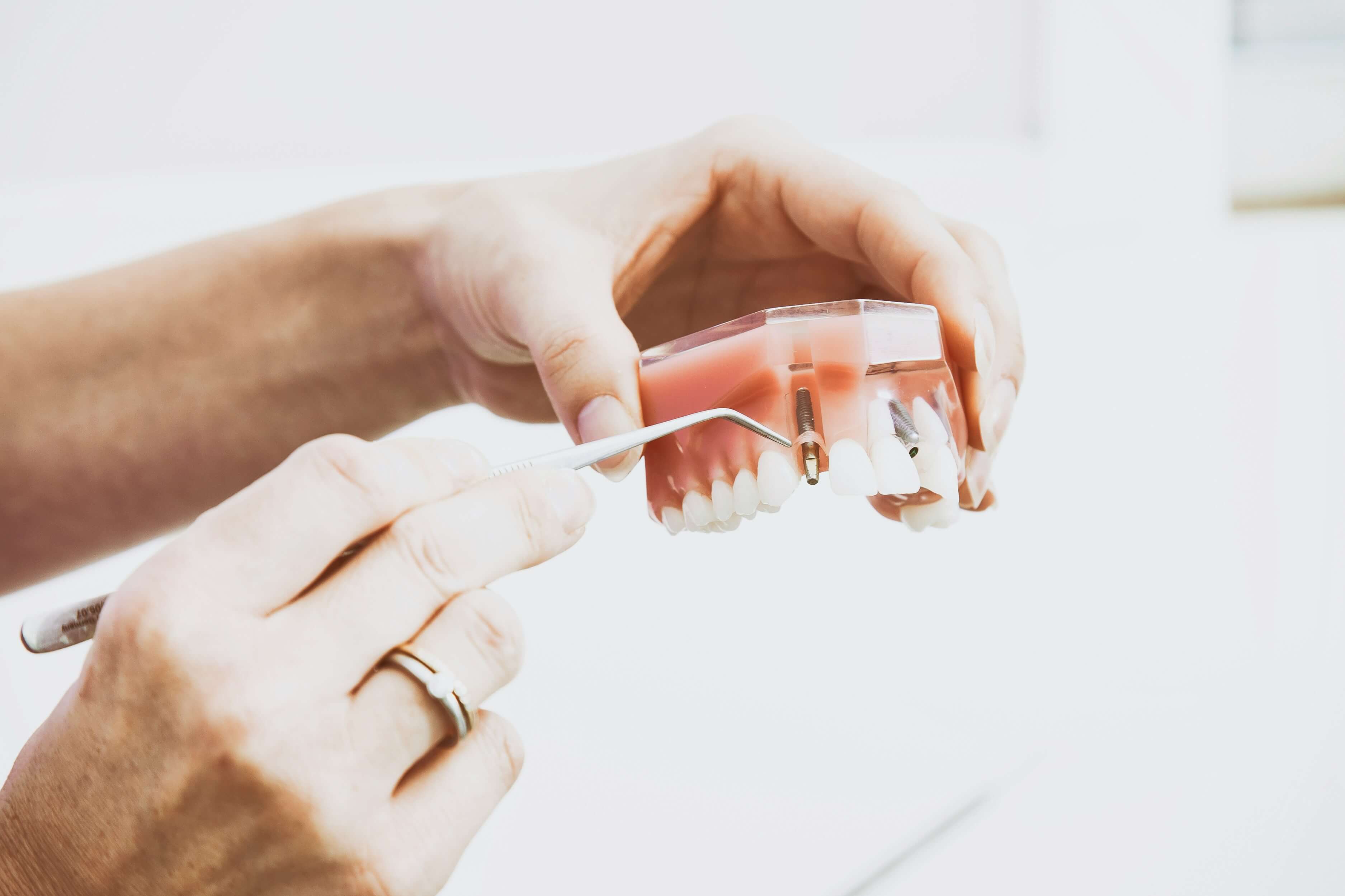 Implantes Dentários: Recupere Seu Sorriso com Segurança